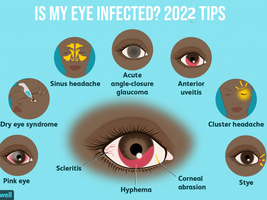 Is My Eye Infected? 2022 Tips - Verrolyne Training