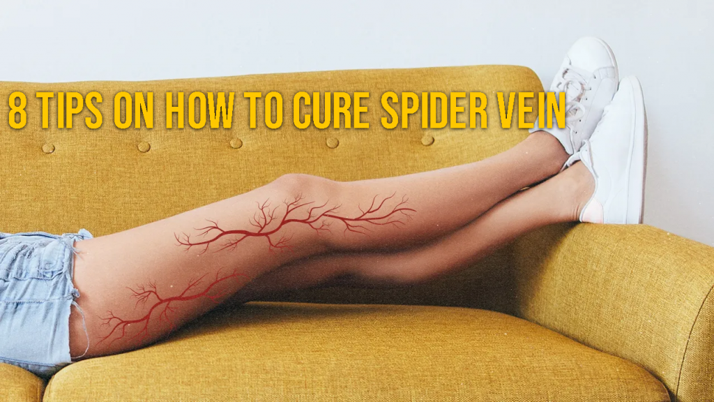8 Tips On How To Cure Spider Veins