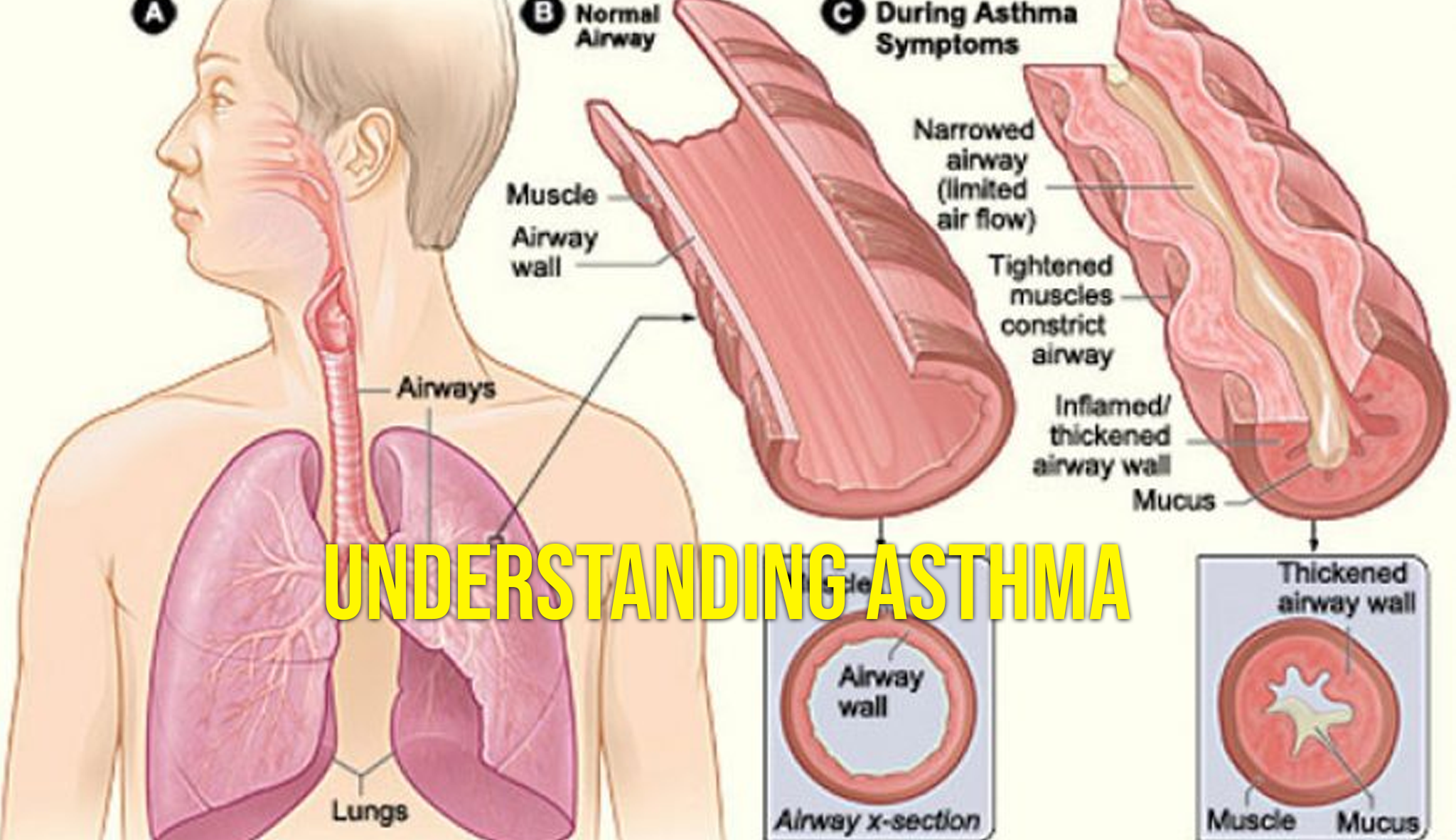 Understanding Asthma - Verrolyne Training